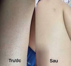 Trị viêm lỗ chân lông 1/2 chân