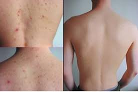 Trị viêm lỗ chân lông 1/2 lưng