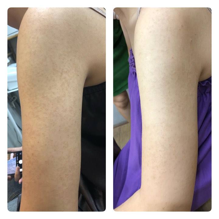Trị viêm lỗ chân lông 1/2 tay