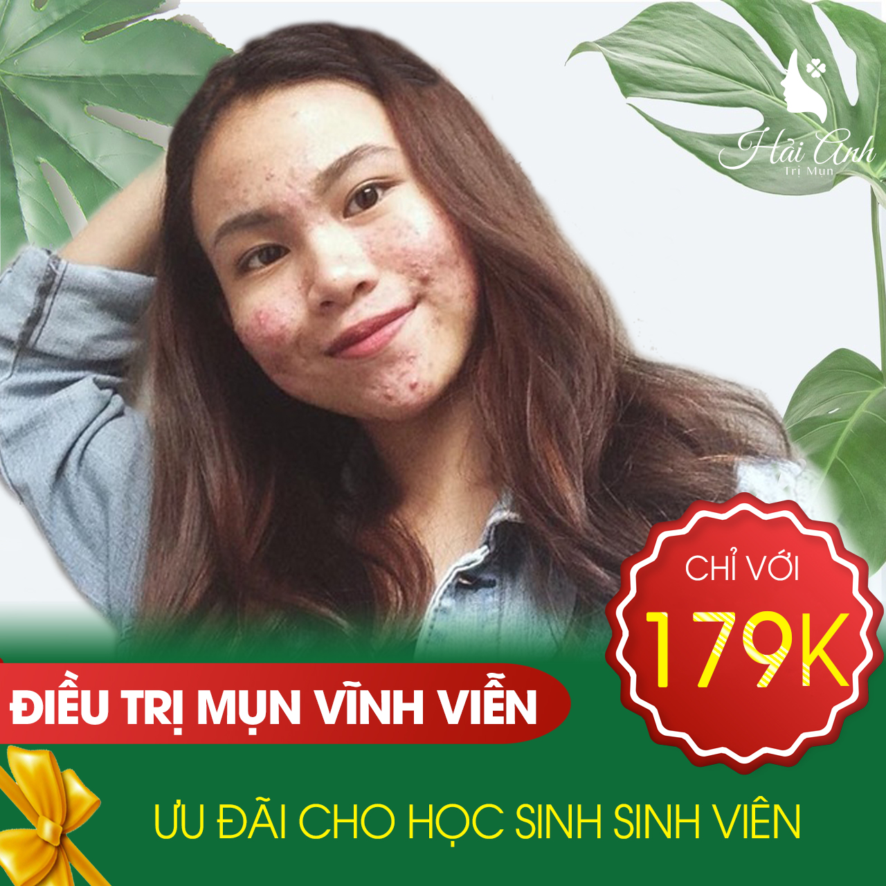 Ưu đãi mùa tựu trường - Trị mụn giá sinh viên chỉ với 179K