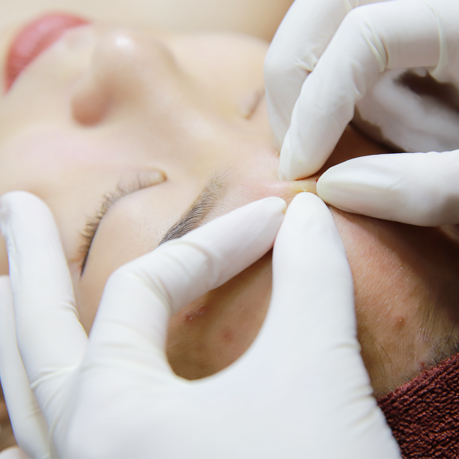 Mụn CS Ngụy Như